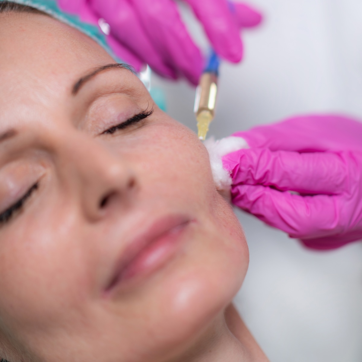 A woman receiving cheek filler injections