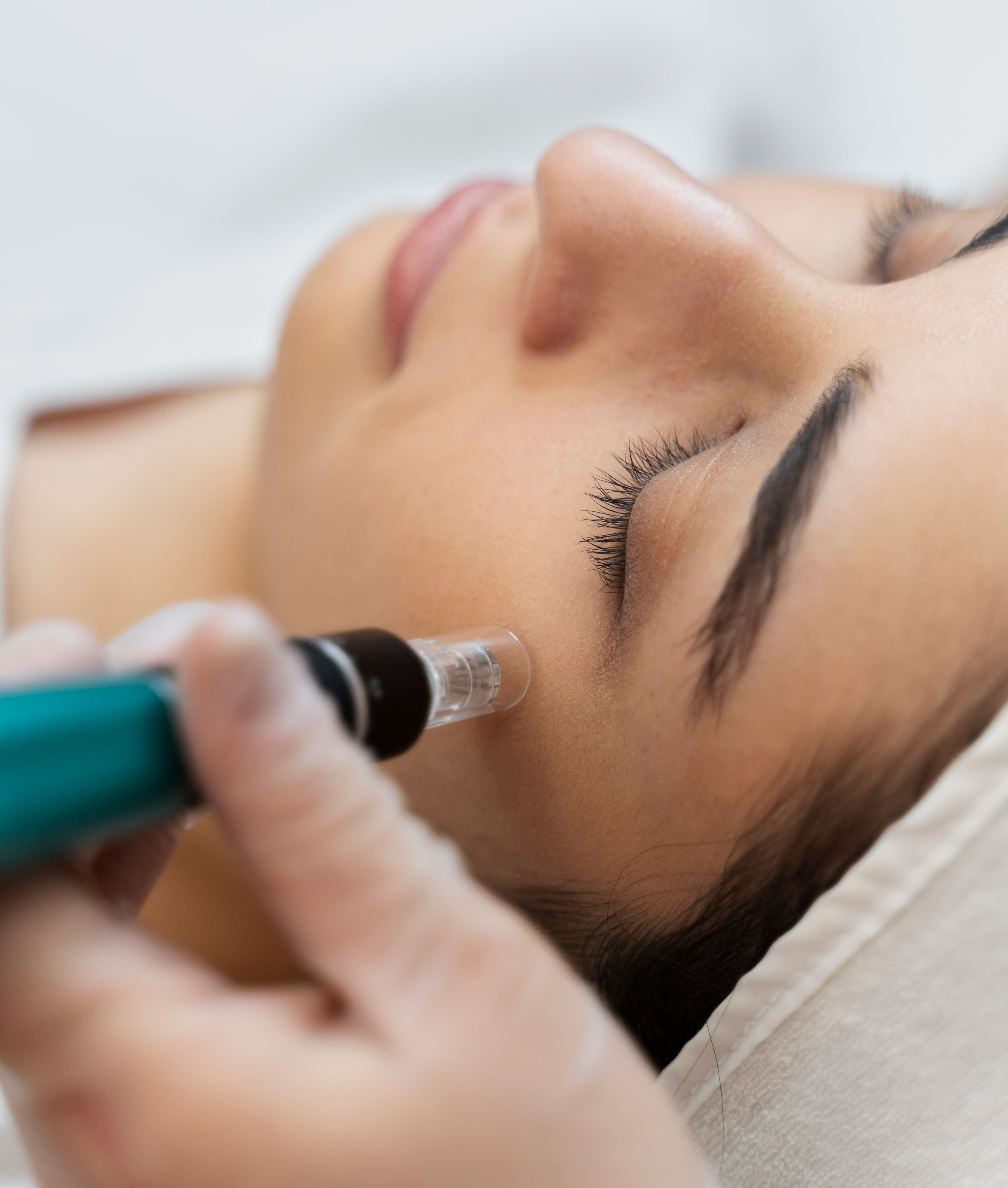 A woman receiving microneedling treatment on her face